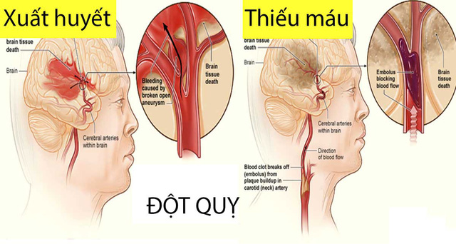 9 dấu hiệu cảnh báo đột quỵ não - Ảnh 3.