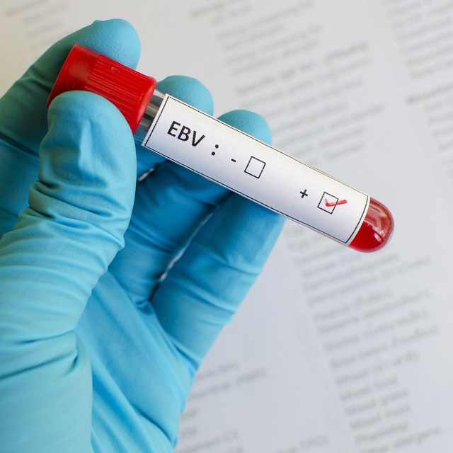 Bệnh nụ hôn sẽ chuyển thành ung thư vòm họng? - Ảnh 2.