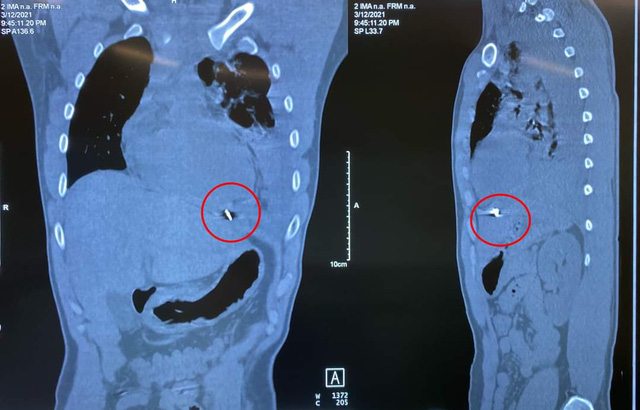 Cấp cứu thành công vết thương tim do dị vật kim khí  - Ảnh 1.