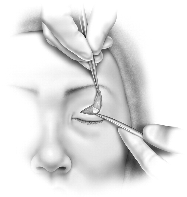 Biến chứng kinh hoàng khi cắt mí tại spa - Ảnh 1.