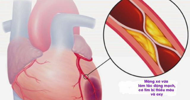 Biến chứng nguy hiểm bệnh thiếu máu cơ tim - Ảnh 1.