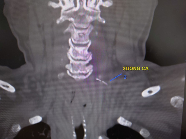 Từ hóc xương cá thành áp-xe trung thất - Ảnh 1.