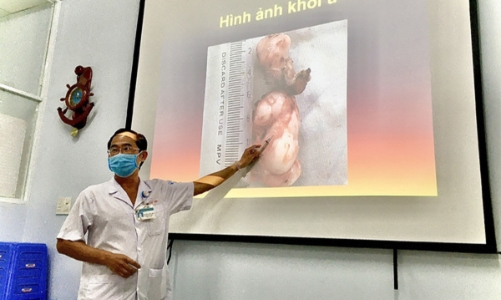Nếu chảy máu cam liên tục, cảnh giác u xơ vòm mũi họng