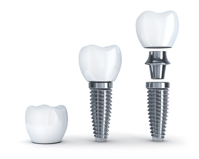 Trụ Implant nào tốt và phù hợp với bạn? - Ảnh 1.