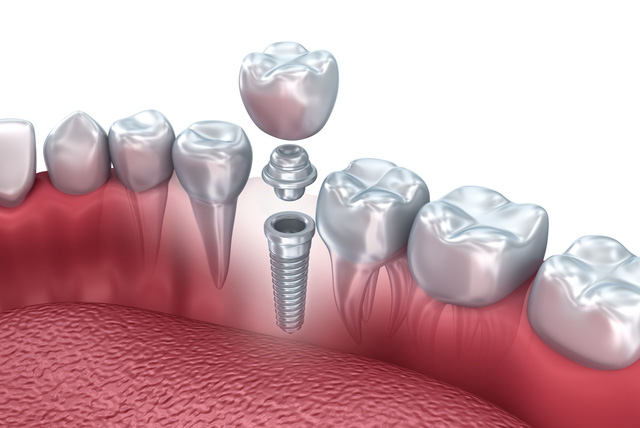 Trụ Implant nào tốt và phù hợp với bạn? - Ảnh 3.