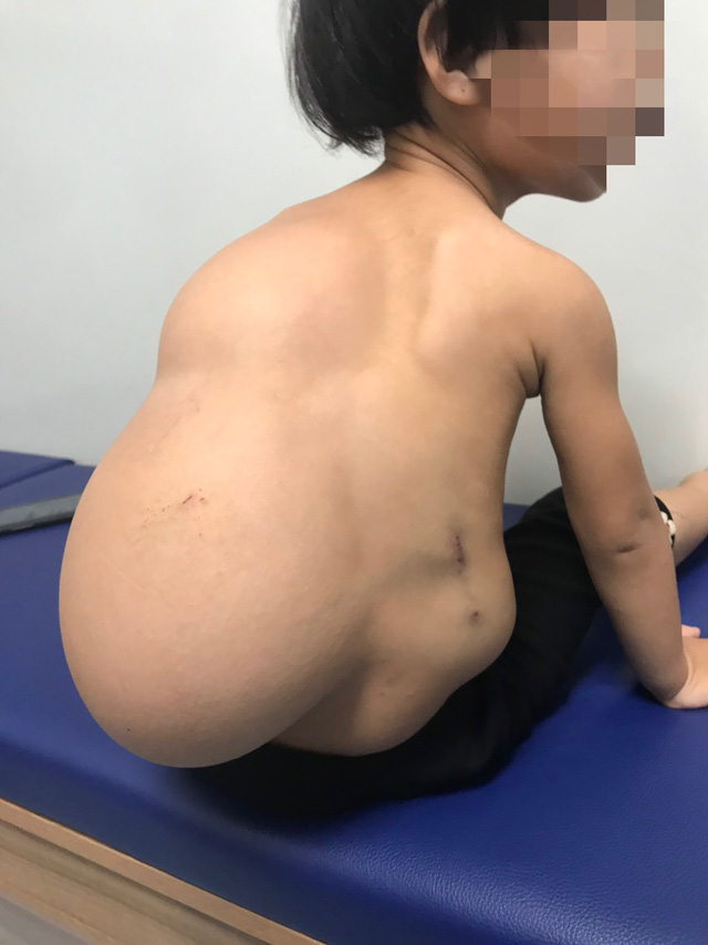 Loại bỏ khối u mỡ khổng lồ cho bé gái 2 tuổi - Ảnh 1.