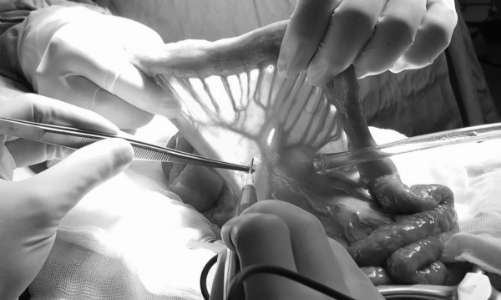 Ghép nối ruột tái tạo đường ăn cho người bệnh ung thư thanh quản