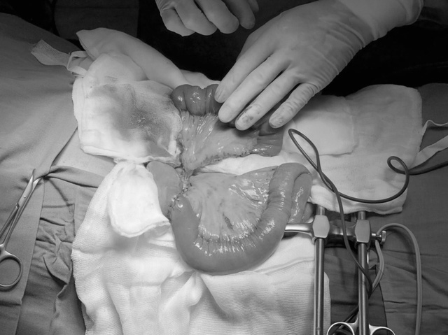 Ghép nối ruột tái tạo đường ăn cho người bệnh ung thư thanh quản  - Ảnh 1.