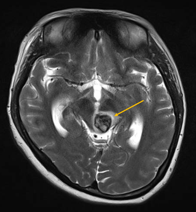 Một sản phụ bị dị dạng mạch m&aacute;u n&atilde;o hiếm gặp - Ảnh 1.