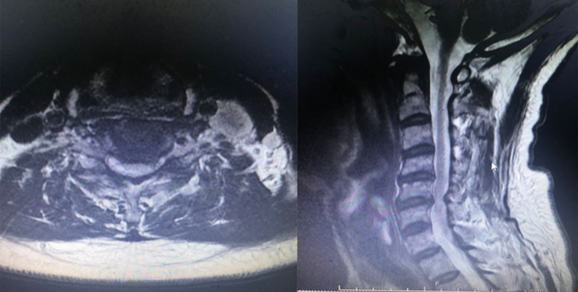 Nguy cơ bại liệt do chấn thương cột sống cổ - Ảnh 1.