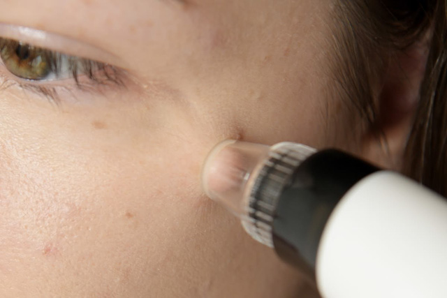 Có nên sắm máy hút mụn cầm tay? - Ảnh 3.