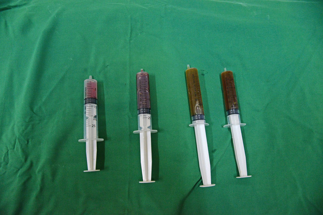 Điều trị nang giáp bằng phương pháp tiêm cồn tuyệt đối - Ảnh 2.