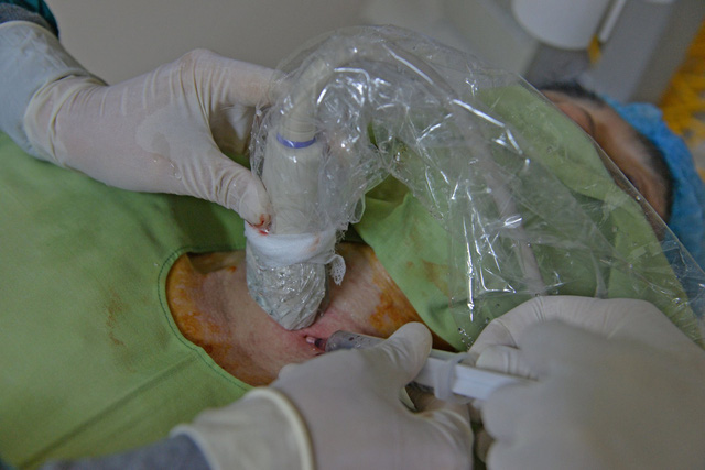 Điều trị nang giáp bằng phương pháp tiêm cồn tuyệt đối - Ảnh 1.