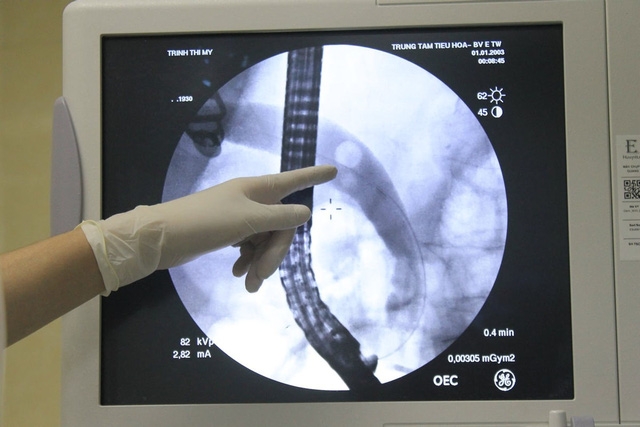 Cứu sống bệnh nhân 91 tuổi bị sỏi ống mật chủ - Ảnh 1.