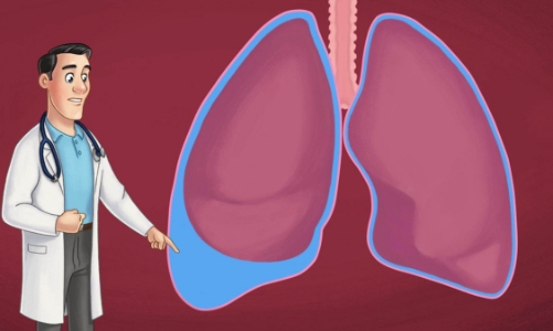 Điều trị tràn dịch màng phổi phải dựa vào nguyên nhân