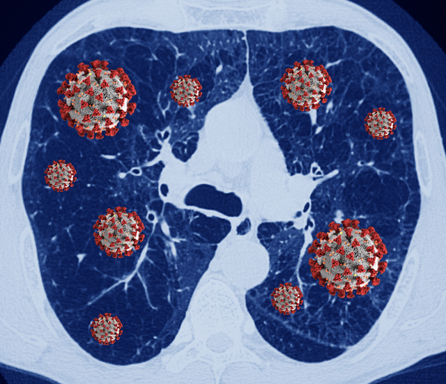 Số ca ung thư phổi phát hiện sớm có nguy cơ giảm do Covid-19 - Ảnh 1.
