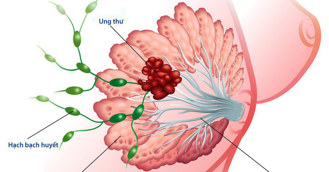 Ung thư vú và phương pháp điều trị không cần phẫu thuật - Ảnh 1.