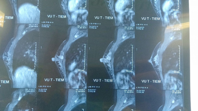 Bệnh ung thư vú có nguy cơ trẻ hóa - Ảnh 1.