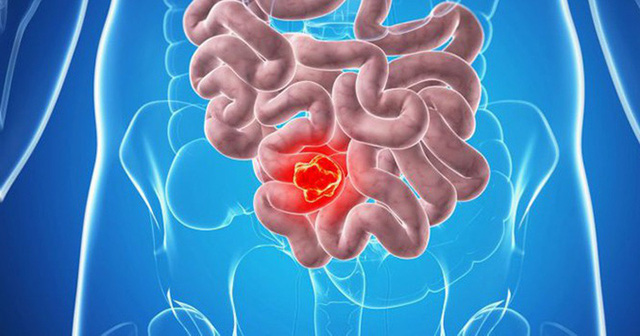 Những lý do để bạn ngừng ăn thịt đỏ - Ảnh 3.