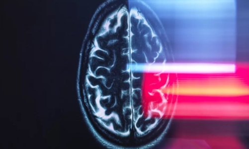 Trí tuệ nhân tạo giúp tầm soát Alzheimer