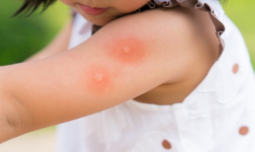 Dịch sốt xuất huyết có nguy cơ bùng phát