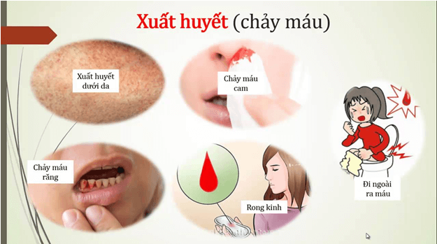 Dịch bệnh sốt xuất huyết vẫn diễn biến phức tạp - Ảnh 2.
