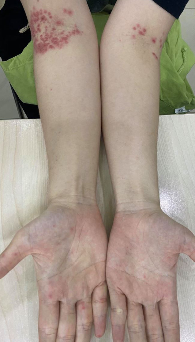 Hy hữu: một người lớn mắc tay chân miệng - Ảnh 1.