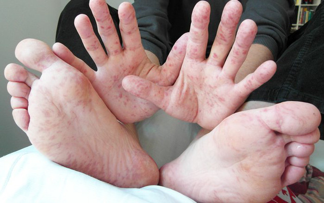 Hy hữu: một người lớn mắc tay chân miệng - Ảnh 2.