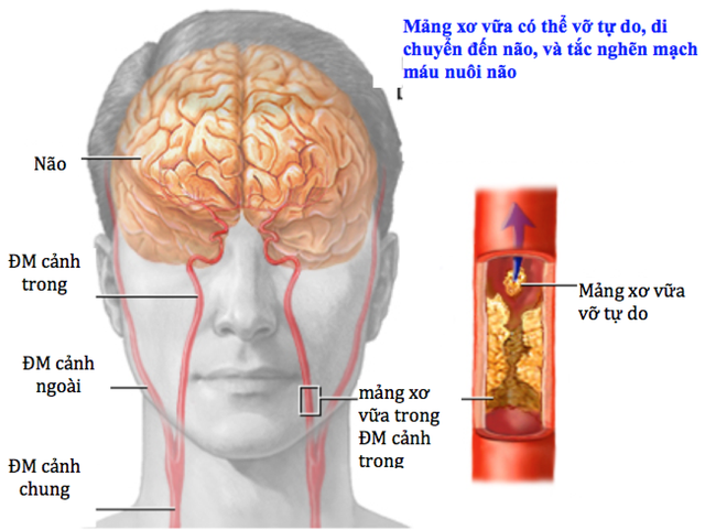 Không chủ quan khi có thiếu máu não cục bộ thoáng qua - Ảnh 1.