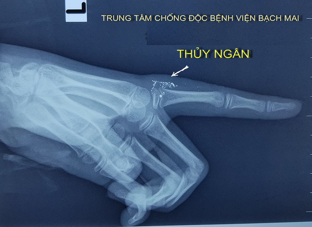 Nhiễm độc thủy ngân do tai nạn khi vẩy nhiệt kế - Ảnh 1.