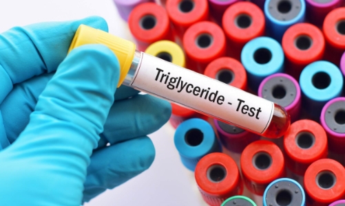 U vàng phát ban do tăng triglycerid máu