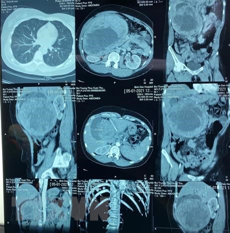 Phẫu thuật tách khối u đầu tụy khổng lồ cứu sống bệnh nhân nữ - Ảnh 1.