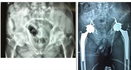 Người uống rượu và hút thuốc cần đề phòng nguy cơ hoại tử vô khuẩn chỏm xương đùi - Ảnh 1.