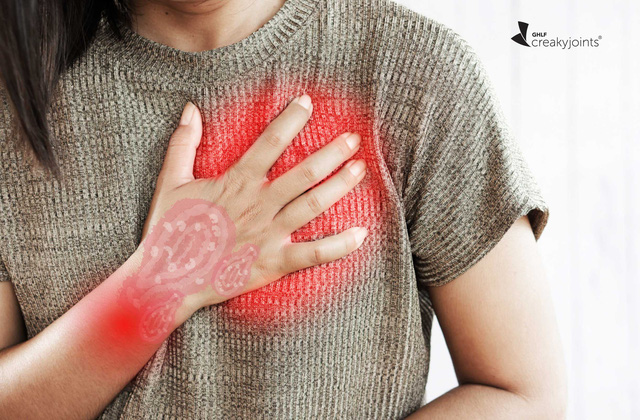 Bệnh vảy nến và những nguy cơ khó lường - Ảnh 2.