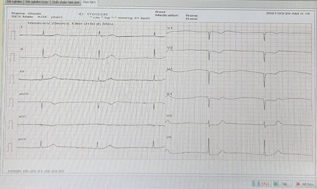 Theo dõi sát sao và phản ứng nhanh giúp cứu sống người nhồi máu cơ tim cấp - Ảnh 1.