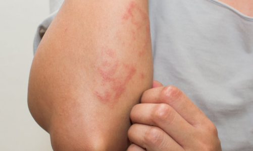 Ngoài triệu chứng hô hấp, Covid-19 còn biểu hiện sớm trên da