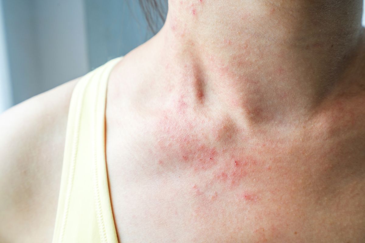 Một triệu chứng trên da đáng chú ý khác là phát ban dạng chàm ở vùng cổ và ngực thường có màu hồng và có thể ngứa.