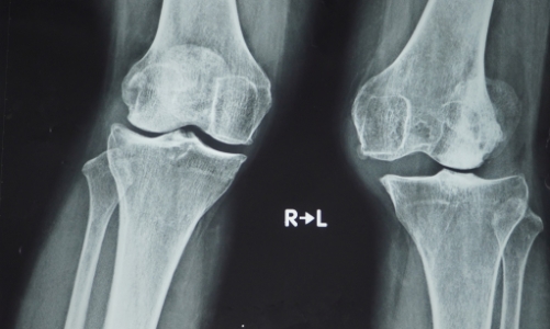 Thay khớp gối dạng 