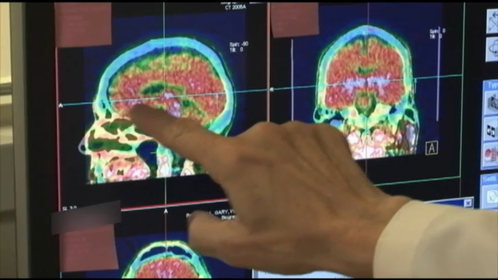 Thể t&iacute;ch chất x&aacute;m ở những bệnh nh&acirc;n được chữa trị bằng liệu ph&aacute;p &ocirc;xy giảm đ&aacute;ng kể so với những bệnh nh&acirc;n kh&ocirc;ng tiếp nhận liệu ph&aacute;p n&agrave;y.