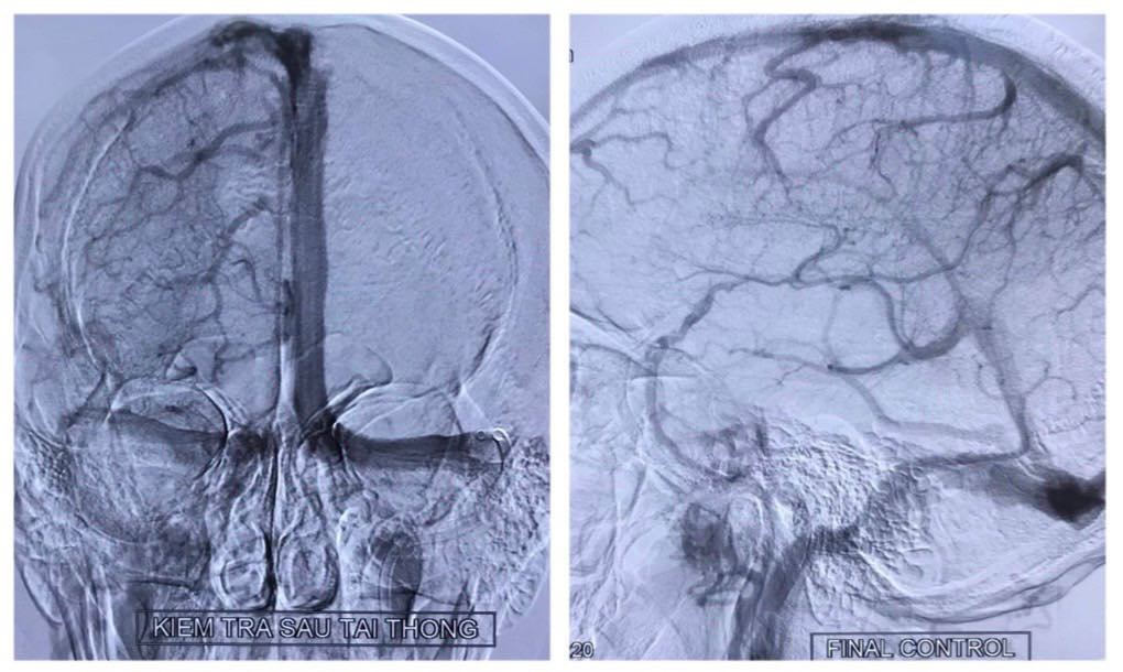 Phim chụp sau can thiệp cho thấy c&aacute;c xoang tĩnh mạch t&aacute;i th&ocirc;ng ho&agrave;n to&agrave;n, kh&ocirc;ng c&oacute; t&igrave;nh trạng ứ trệ c&aacute;c tĩnh mạch n&atilde;o.