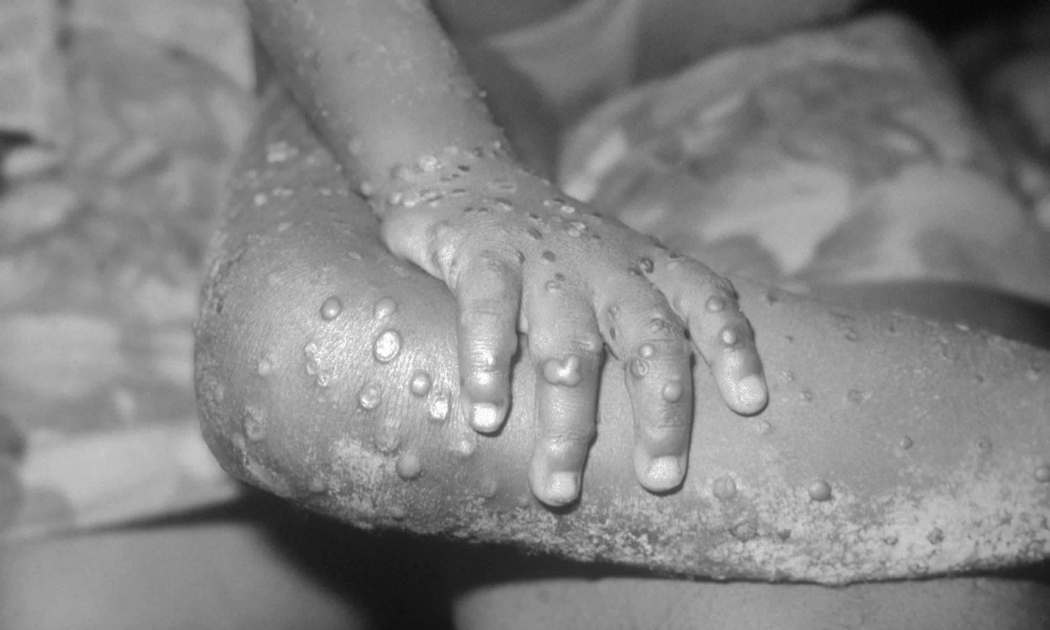 Các tổn thương giống với đậu mùa khỉ ở tay và chân một bé gái tại Bondua, Liberia năm 1971 - Ảnh: CDC Mỹ