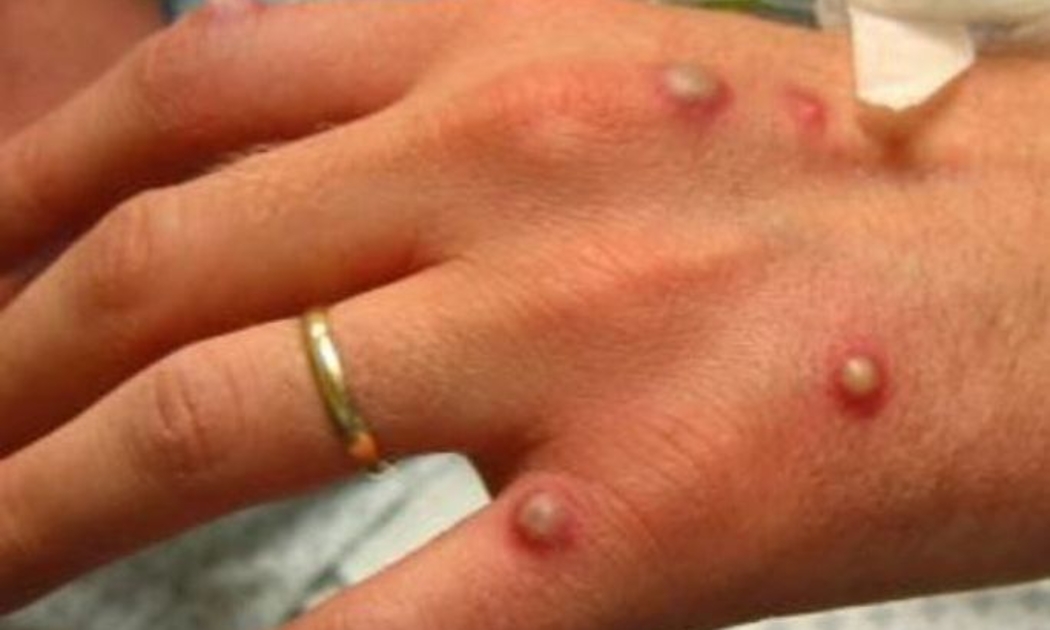 Bàn tay một bệnh nhân đậu mùa khỉ nổi mụn nước Ảnh: MEDSCAPE