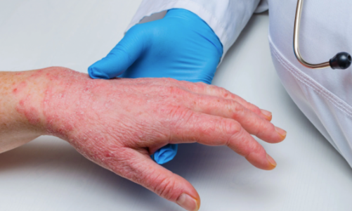 Giám sát chặt cửa khẩu phát hiện ca nghi ngờ bệnh đậu mùa khỉ