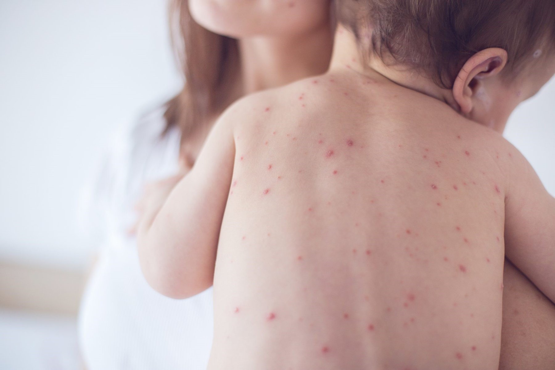 Trong 3 ngày đầu của bệnh rất khó để phân biệt sốt xuất huyết và tay chân miệng vì các dấu hiệu của hai bệnh này tương đối giống nhau. 