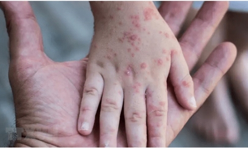 TP. HCM giám sát cửa khẩu để phát hiện ca nghi ngờ bệnh đậu mùa khỉ