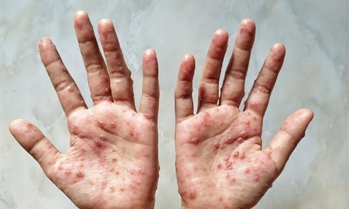 Bộ Y tế hướng dẫn chẩn đoán, điều trị bệnh đậu mùa khỉ