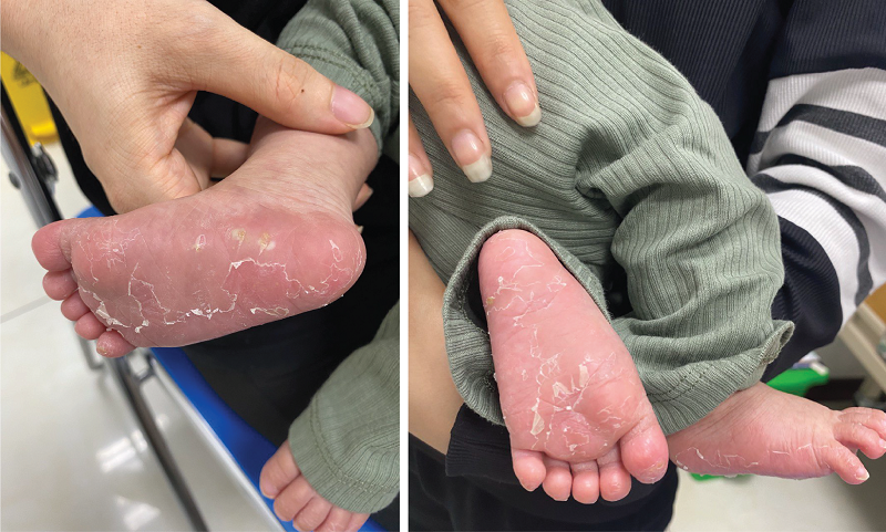 Bệnh nh&acirc;n nhi đến kh&aacute;m với c&aacute;c triệu chứng bong tr&oacute;c da tay, ch&acirc;n;&nbsp;quấy kh&oacute;c kh&ocirc;ng r&otilde; nguy&ecirc;n nh&acirc;n...