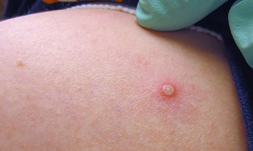 Đo thân nhiệt tại cửa khẩu để giám sát, phát hiện bệnh đậu mùa khỉ