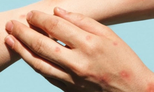 Có ca bệnh đậu mùa khỉ đầu tiên, Việt Nam chuẩn bị kịch bản ứng phó ra sao?