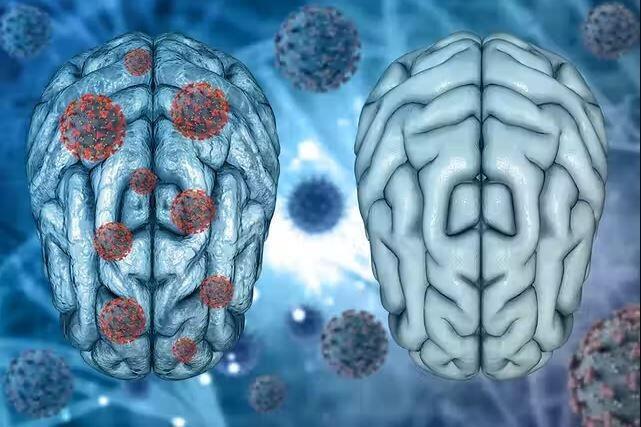 Di chứng hậu Covid-19 được ghi nhận ảnh hưởng đến thần kinh người mắc bệnh. Ảnh: Bộ Y tế